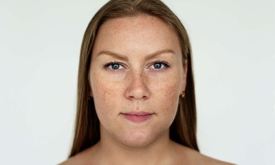 أسباب الكلف وطرق علاجه