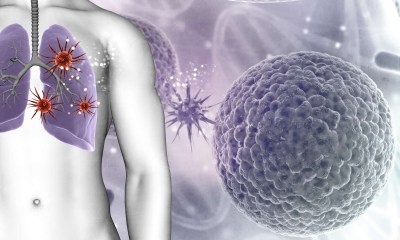 أورام الرئة