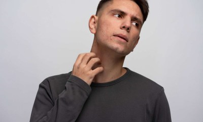 تهيج جلدي في الدقن