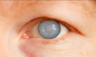 أمراض العين