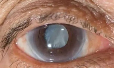 أمراض العين