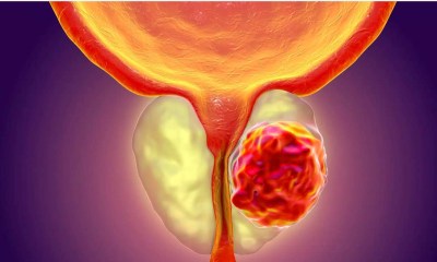 أمراض البروستاتا