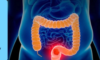 البروستاتا