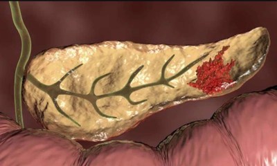 أورام البنكرياس