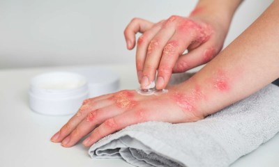 الحروق و تهيج للجلد