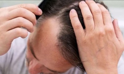 الصلع الوراثي