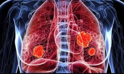 أورام الرئة