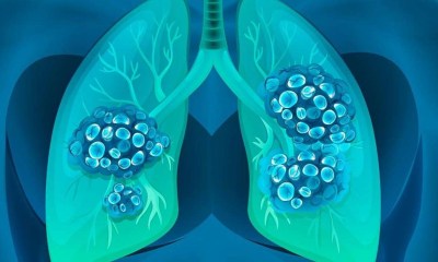 أورام الرئة