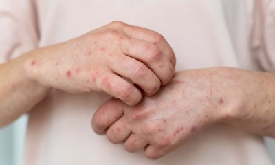 نيويورك تعلن حالة طوارئ بسبب الحصبة