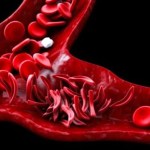 الموافقة على أول علاج لفقر الدم لمرضى الثلاسيميا 