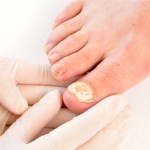 علاج جديد لمرضى عدوى فطريات أظافر القدم