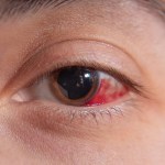 الضمور البقعي في العين