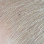 دليل الرجل للتعامل مع قمل العانة