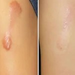  العلاجات المناسبة لندبة الجدرة