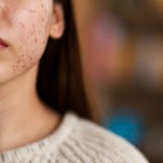 احذر  هذه البثور.. قد تكون مؤشرا خطيرا على أورام الجلد
