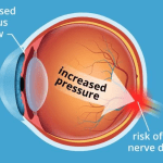 خطر فقدان البصر لدى مستخدمي Wegovy أعلى 5 مرات من Ozempic