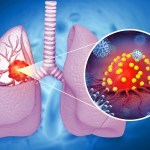 أول لقاح لأورام الرئة في العالم