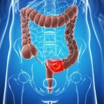 سبب انتشار ورم القولون والمستقيم يتزايد بين الشباب