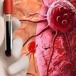 تغييرات في تعليمات علاج أورام الدم تجعله أسهل وأقل إرهاقا للمرضى