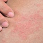10 علاجات منزلية مذهلة تخلصك من الطفح الحراري في أيام