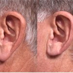 تصغير شحمة الأذن.. موضة تجميلية جديدة تجذب الرجال