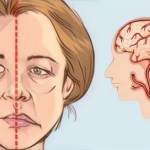5 مضاعفات للحمل قد تنبئ بالسكتة الدماغية بعد عقود