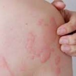 متى تصبح خلايا النحل الجلدية خطيرة؟