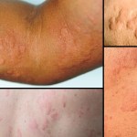 متى تصبح خلايا النحل الجلدية خطيرة؟