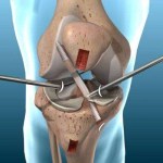 العلاج بالتيستوستيرون خطر على مرضى استبدال الركبة