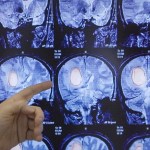 موافقة خاصة على دواء جديد لعلاج ورم نادر في الدماغ