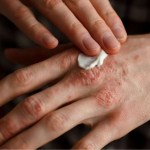 دواء Anzupgo.. أول علاج موضعي غير ستيرويدي للإكزيما المزمنة في اليدين