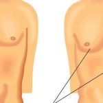 دواء Risperdal يسبب نمو الثدي عند الرجال