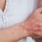 علاج فموي بسيط للصدفية الشديدة على الأبواب