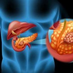 دواء جديد لأورام البنكرياس يحصل على تصنيف المسار السريع من الـFDA