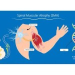 دواء واعد لضمور العضلات يحصل على تصنيف علاج ثوري من FDA