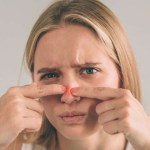 عصر البثور في هذه المنطقة ينقل العدوى مباشرة إلى الدماغ