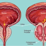 العلاج بالليزر المبرد الموضعي ناجح بنسبة عالية لعلاج أورام البروستاتا