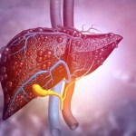 لماذا أصبح مرض الكبد الدهني شائع جداً؟