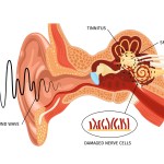 ذكاء اصطناعي يتنبأ بتحسن الكلام بعد زراعة القوقعة للأطفال