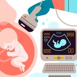 تفاعل أوعية المشيمة يكشف عن عيوب القلب الخِلقية لدى الأجنة