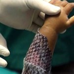 صورة من بي بي سي عن جلد السمك كبديل للترقيع التقليدي