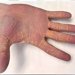 أسباب مرض الزانثلازما