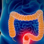 البروستاتا