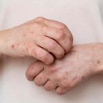 نيويورك تعلن حالة طوارئ بسبب الحصبة